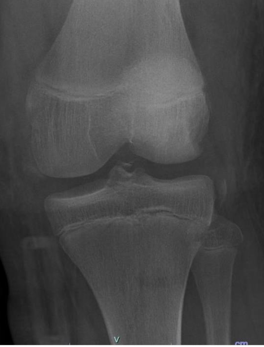 Figure_2_Coexisting_Segond fracture